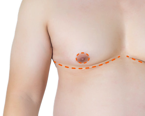 Double incision top surgery incision pattern marked on the chest