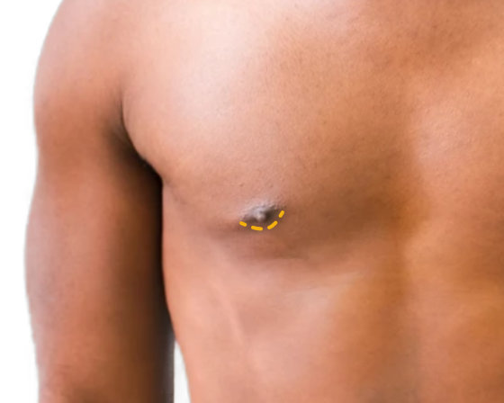 Keyhole top surgery incision marked at the base of the areola