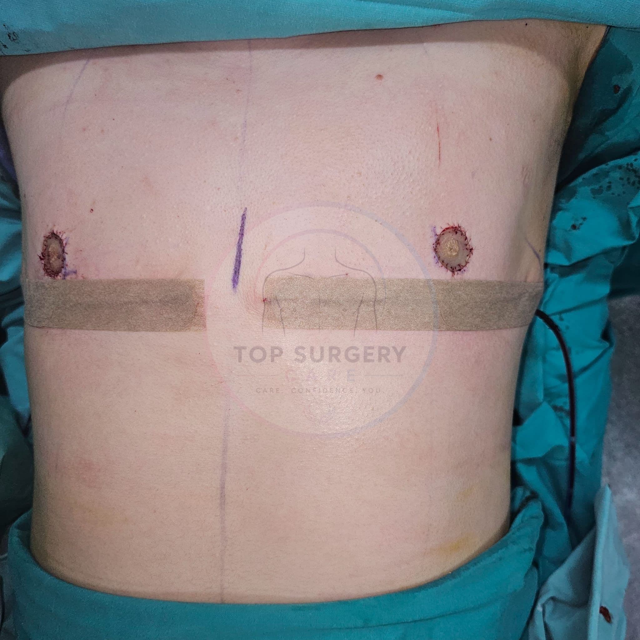 Top surgery before and after result — case 01