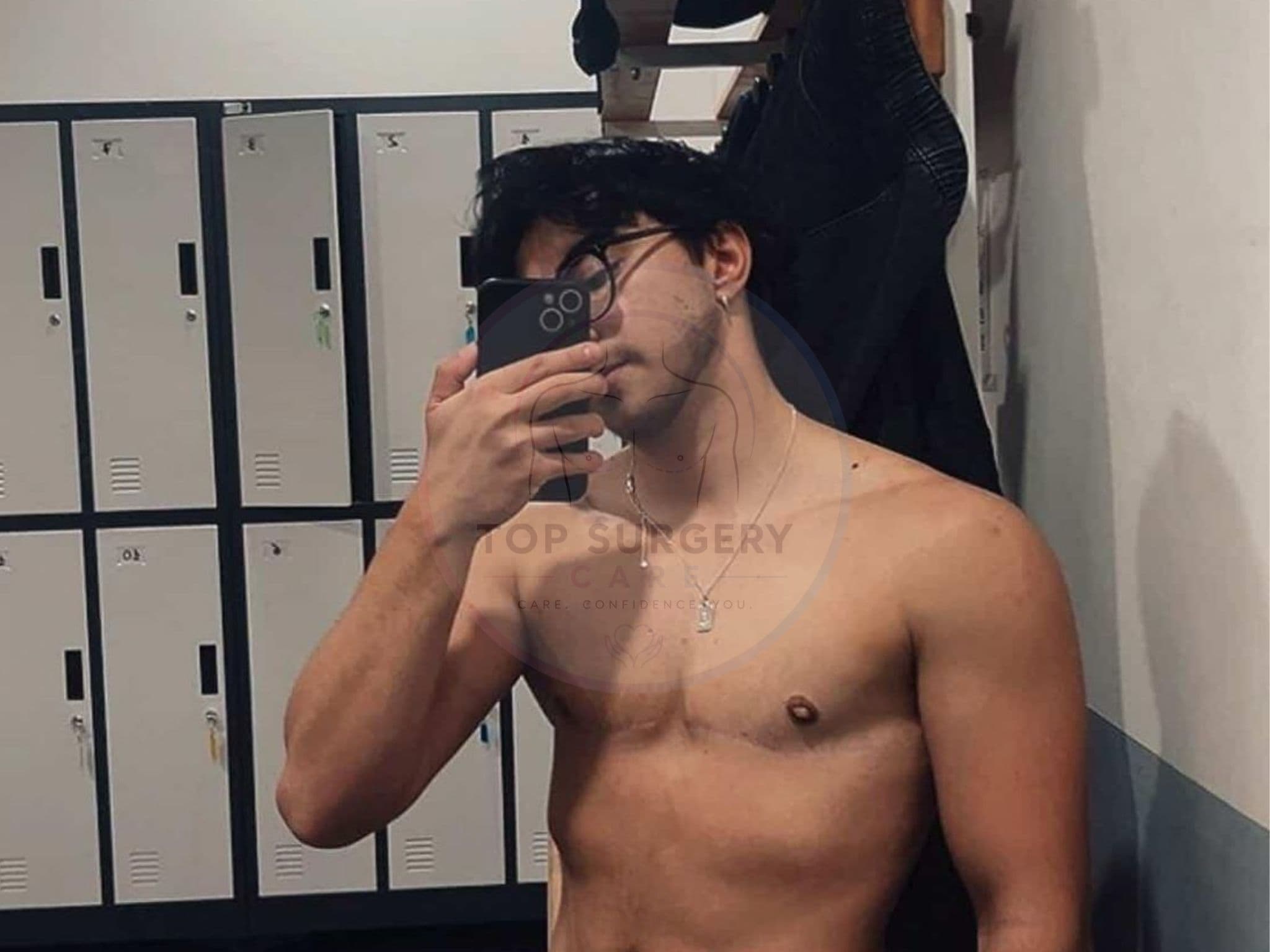 Top surgery before and after result — case 10