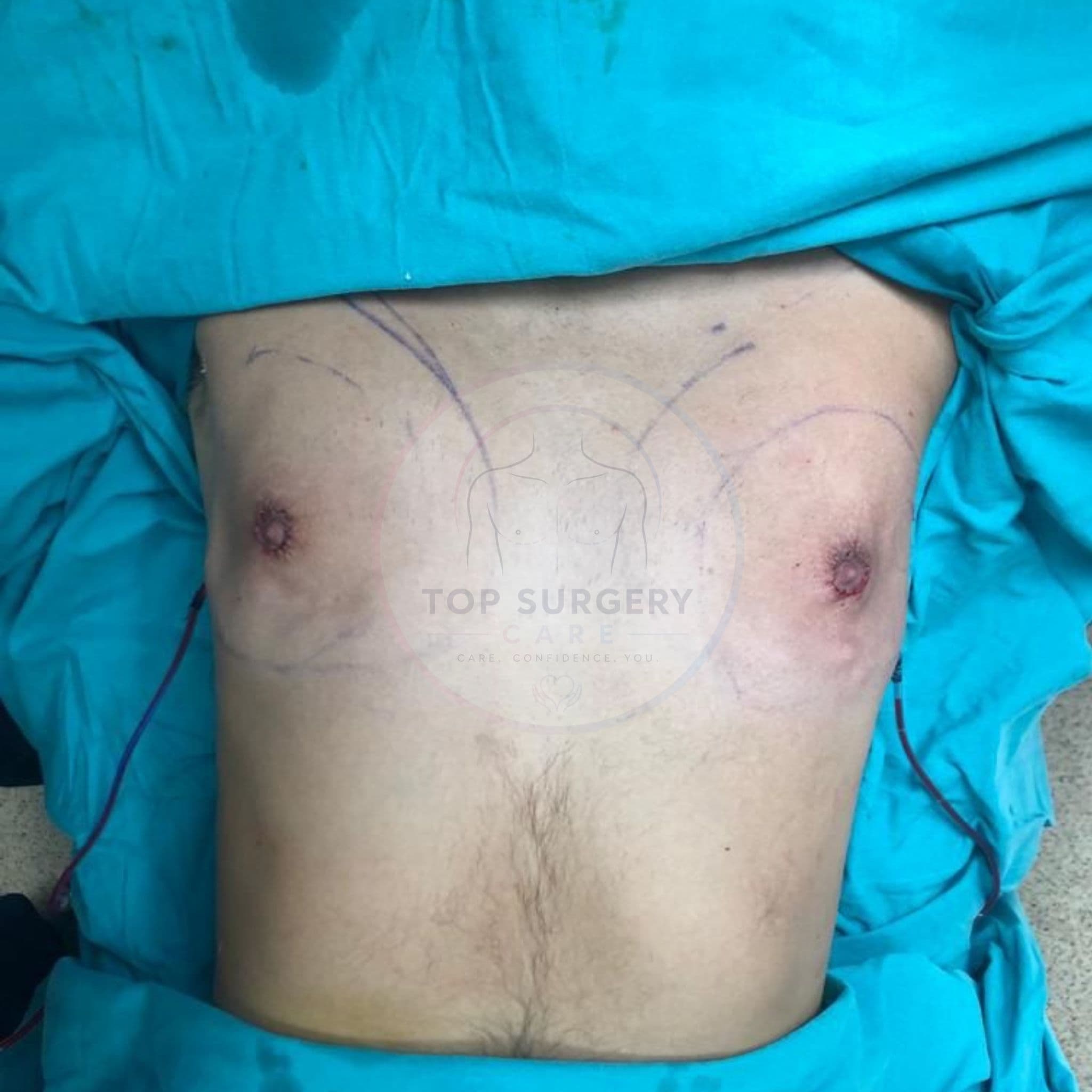 Top surgery before and after result — case 02
