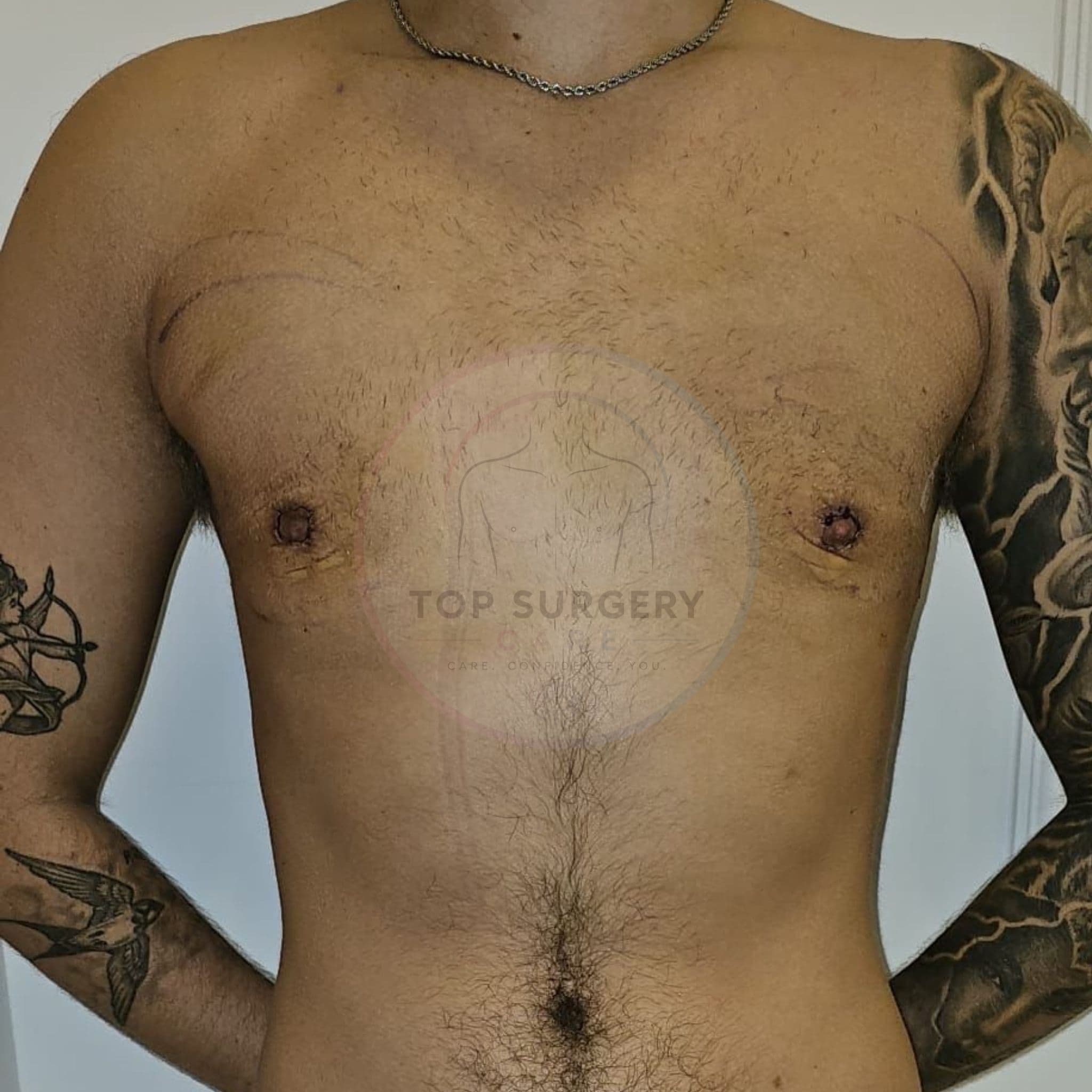 Top surgery before and after result — case 03