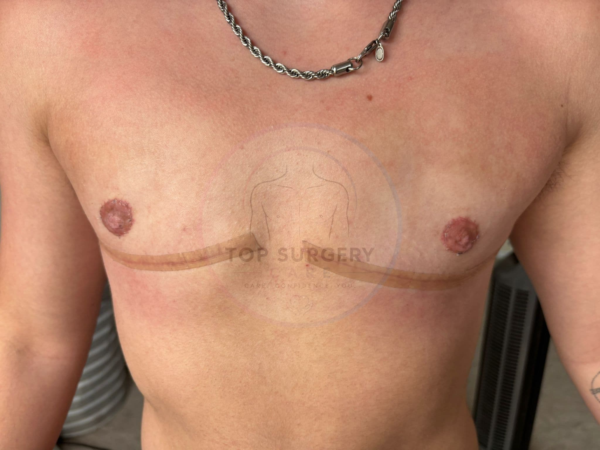 Top surgery before and after result — case 04