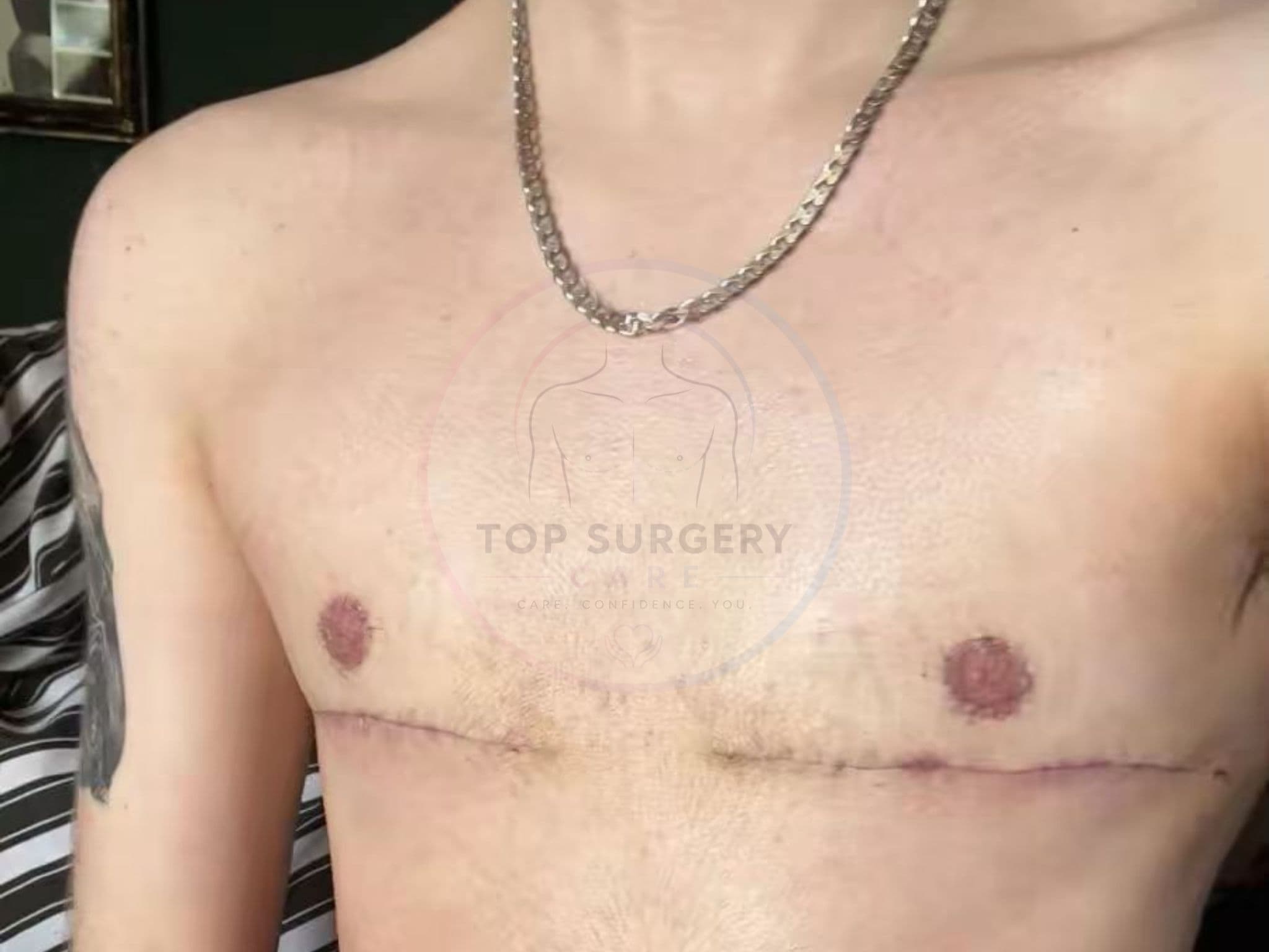 Top surgery before and after result — case 06