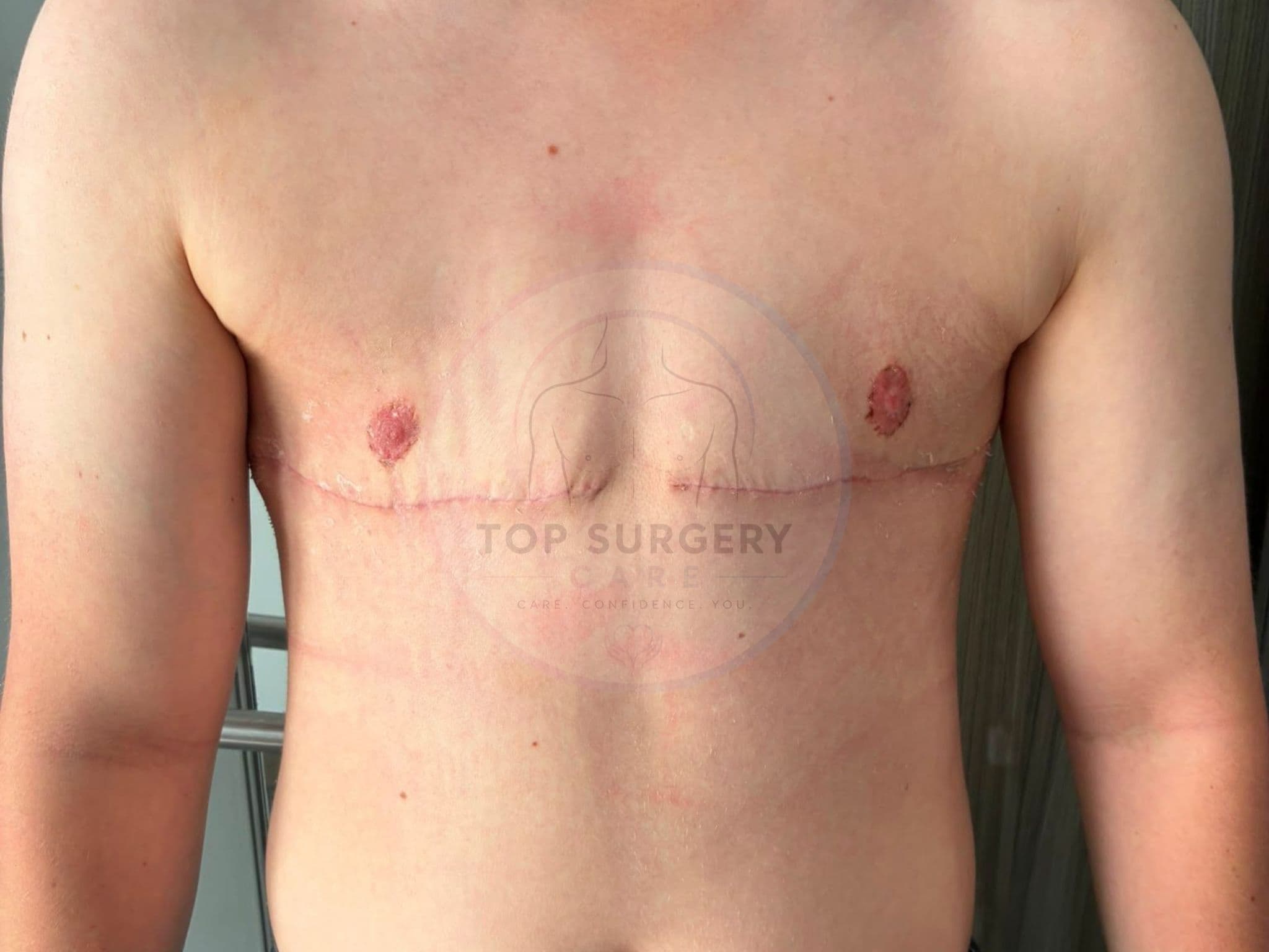 Top surgery before and after result — case 07