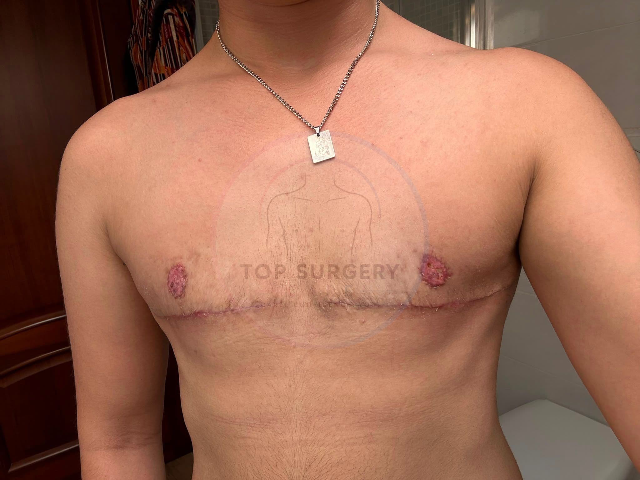 Top surgery before and after result — case 08