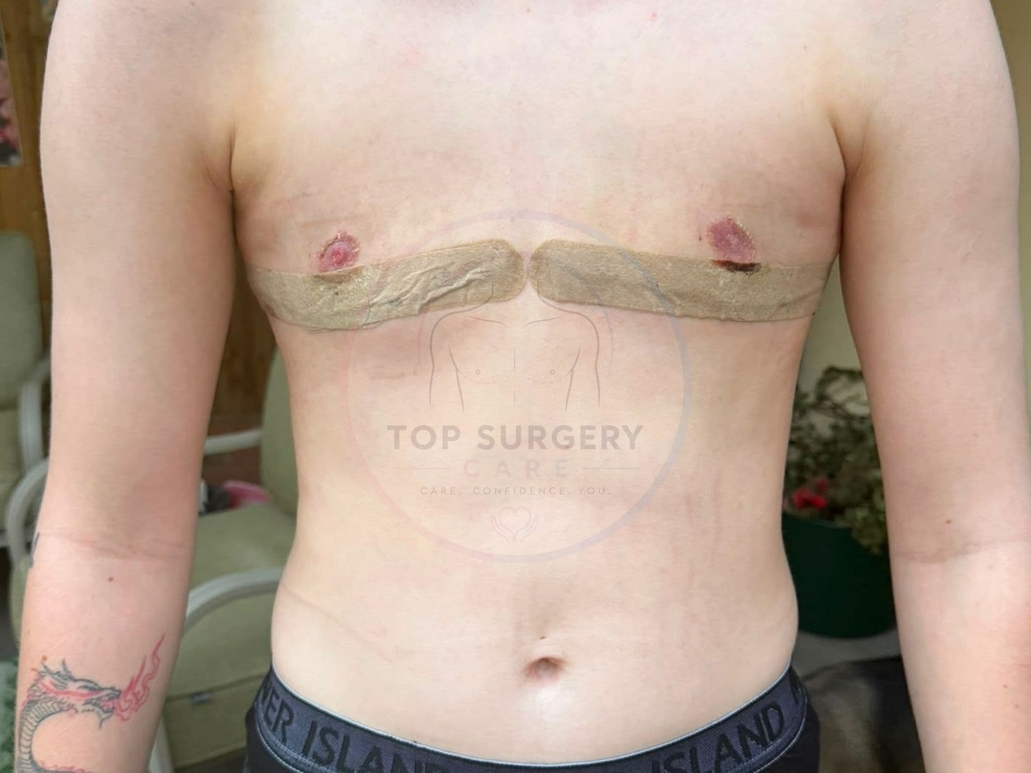 Top surgery before and after result — case 09